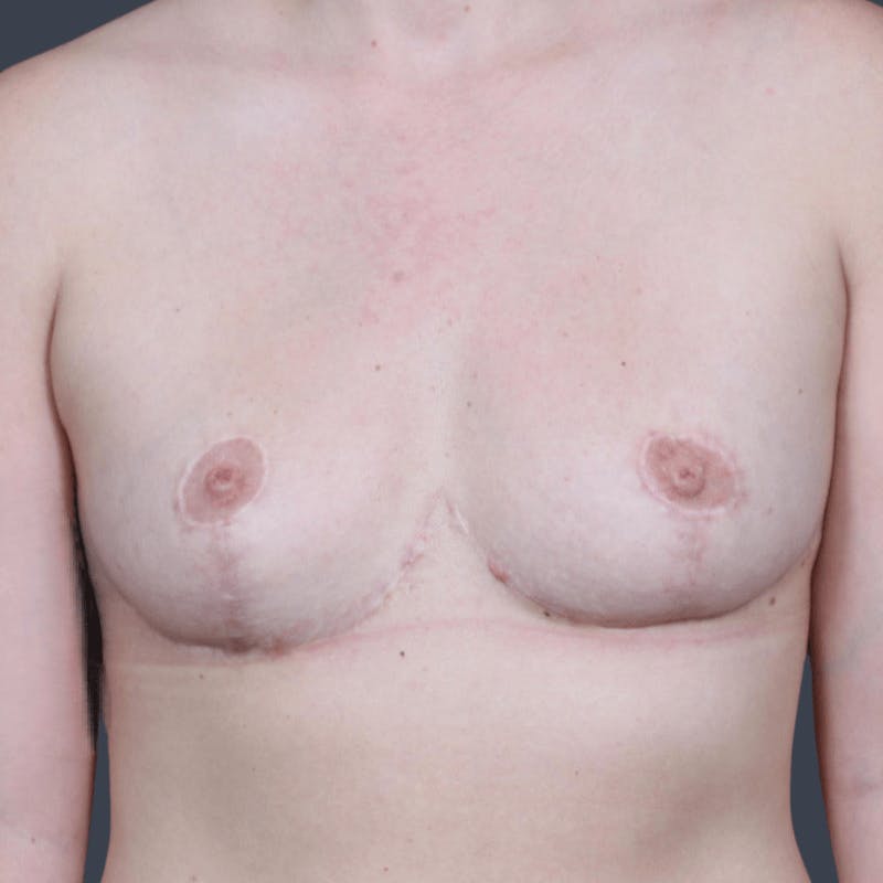 Breast Reduction Before & After Gallery - Patient 280417 - Image 2