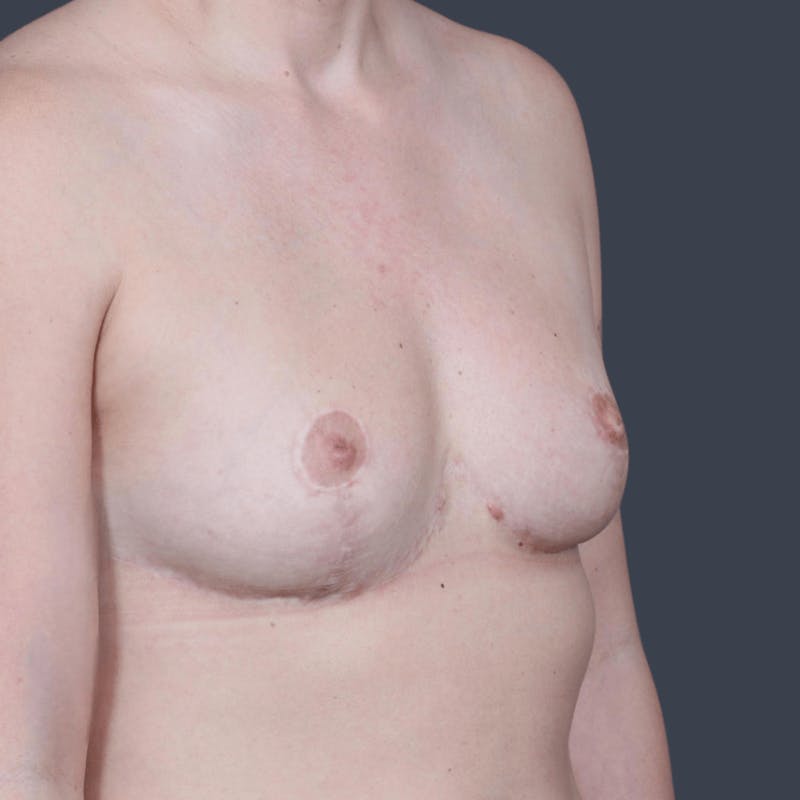 Breast Reduction Before & After Gallery - Patient 280417 - Image 4