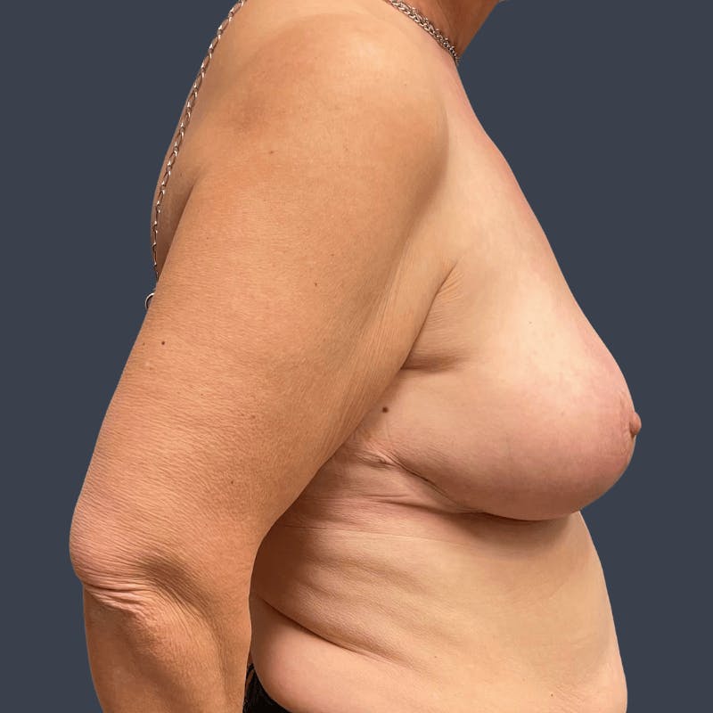 Breast Reduction Before & After Gallery - Patient 303757 - Image 4