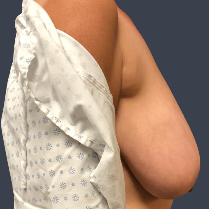 Breast Reduction Before & After Gallery - Patient 303757 - Image 3