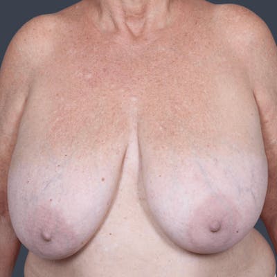 Breast Reduction Before & After Gallery - Patient 234336 - Image 1