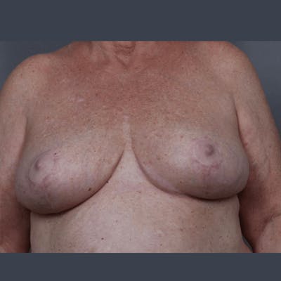 Breast Reduction Before & After Gallery - Patient 234336 - Image 2