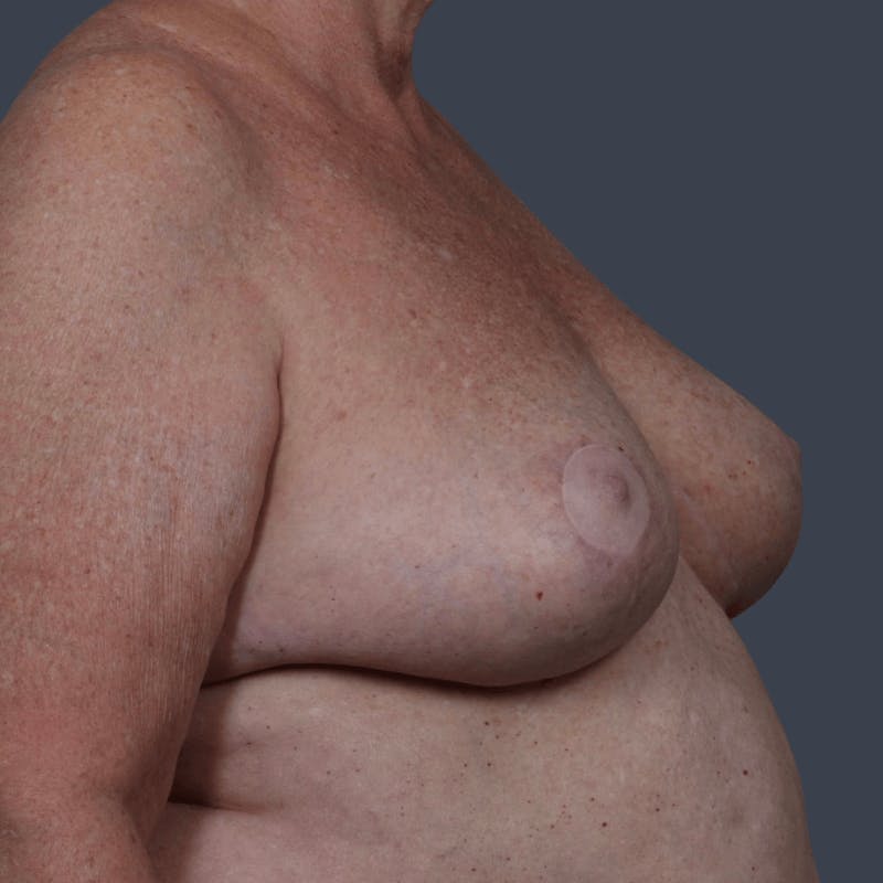 Breast Reduction Before & After Gallery - Patient 234336 - Image 4