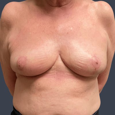 Breast Reduction Before & After Gallery - Patient 307228 - Image 2