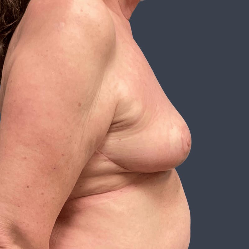 Breast Reduction Before & After Gallery - Patient 307228 - Image 4
