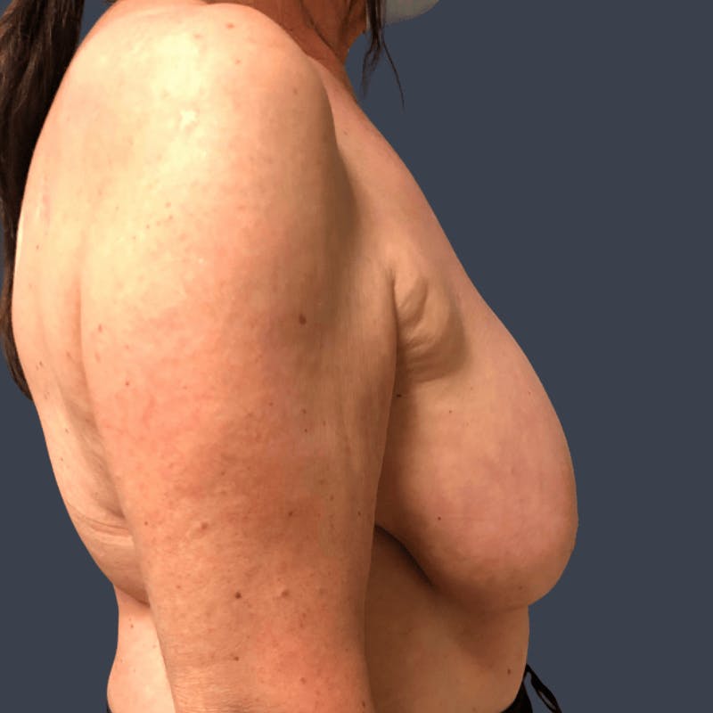 Breast Reduction Before & After Gallery - Patient 307228 - Image 3