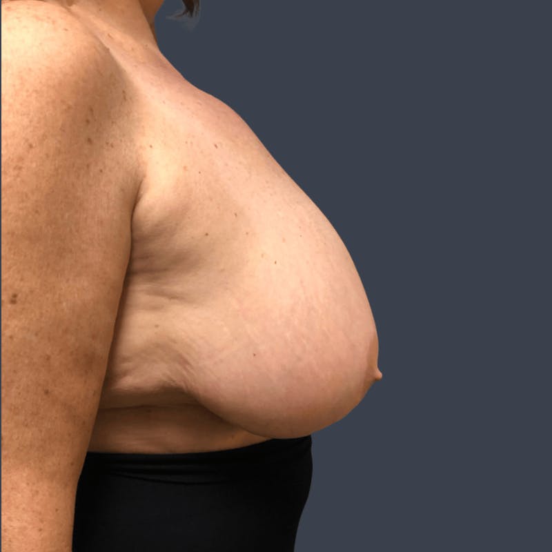 Breast Reduction Before & After Gallery - Patient 291184 - Image 3