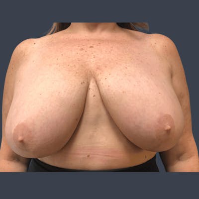 Breast Reduction Before & After Gallery - Patient 291184 - Image 1