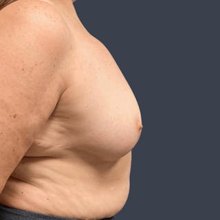 Breast Reduction Before & After Gallery - Patient 291184 - Image 4