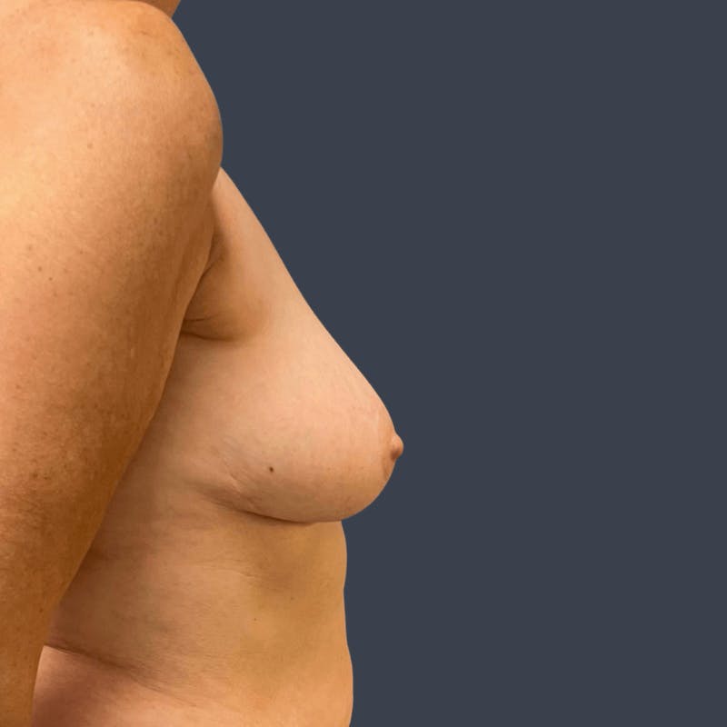 Breast Reduction Before & After Gallery - Patient 403024 - Image 4