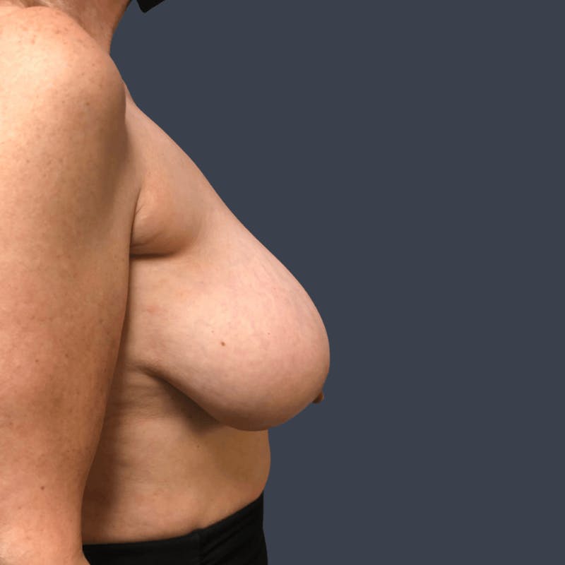 Breast Reduction Before & After Gallery - Patient 403024 - Image 3