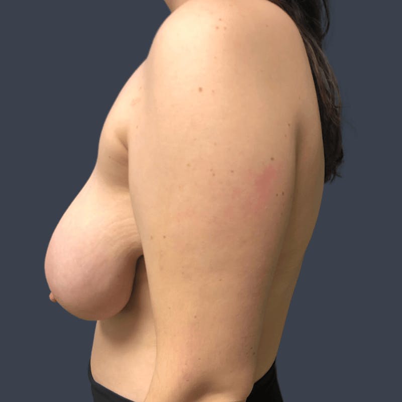 Breast Reduction Before & After Gallery - Patient 419889 - Image 3
