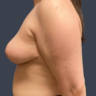 Breast Reduction Before & After Gallery - Patient 419889 - Image 4