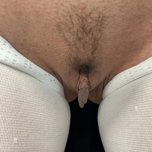 Before procedure image for Labiaplasty