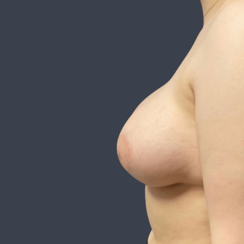 Breast Augmentation Before & After Gallery - Patient 378278 - Image 4