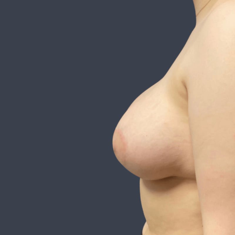 Breast Asymmetry / Tuberous Breasts Before & After Gallery - Patient 339633 - Image 4
