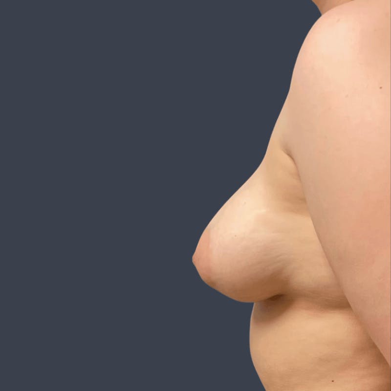 Breast Asymmetry / Tuberous Breasts Before & After Gallery - Patient 339633 - Image 3