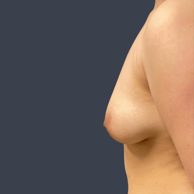 Breast Augmentation Before & After Gallery - Patient 191861 - Image 5