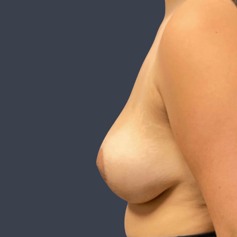 Breast Augmentation Before & After Gallery - Patient 191861 - Image 6