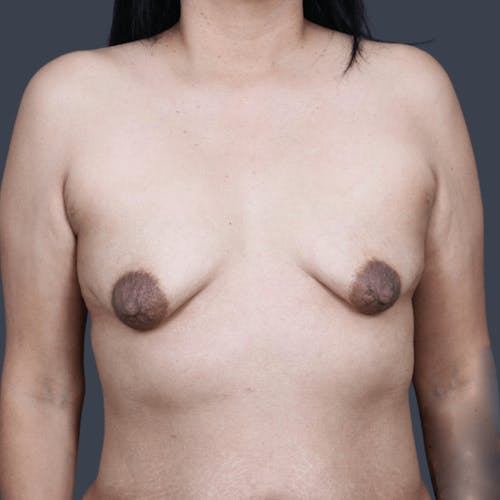 Before procedure image for Breast Asymmetry / Tuberous Breasts