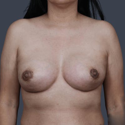 Breast Asymmetry / Tuberous Breasts Before & After Gallery - Patient 240445 - Image 2