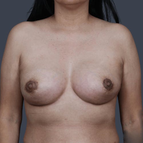 After procedure image for Breast Asymmetry / Tuberous Breasts