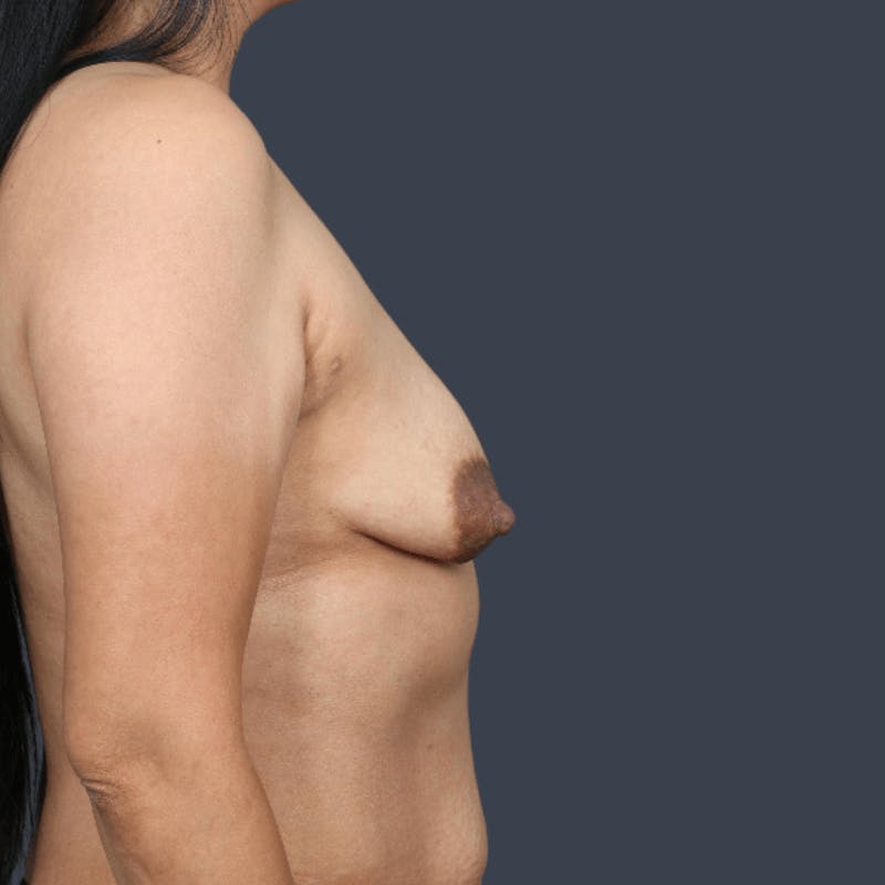 Breast Augmentation Before & After Gallery - Patient 260381 - Image 5