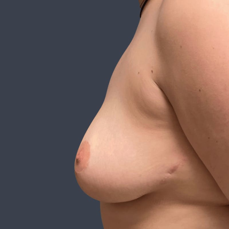 Breast Asymmetry / Tuberous Breasts Before & After Gallery - Patient 280706 - Image 4