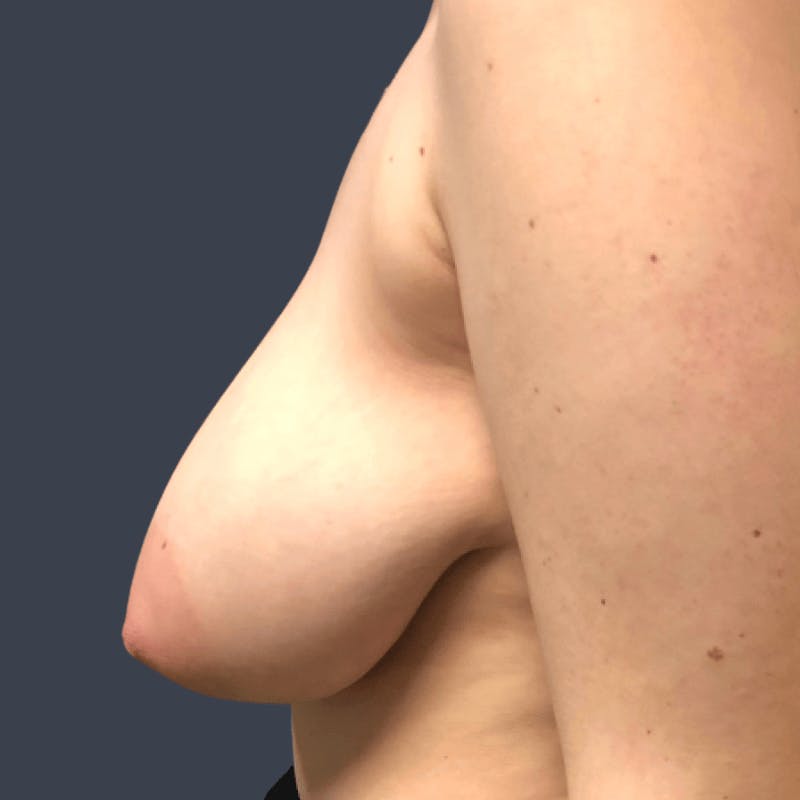 Breast Asymmetry / Tuberous Breasts Before & After Gallery - Patient 280706 - Image 3