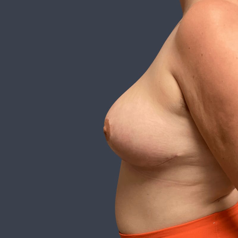 Breast Asymmetry / Tuberous Breasts Before & After Gallery - Patient 339772 - Image 4