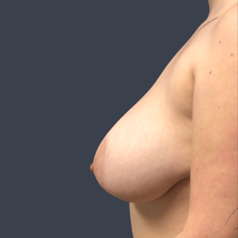 Breast Asymmetry / Tuberous Breasts Before & After Gallery - Patient 339772 - Image 3