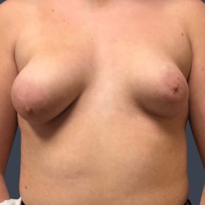 Breast Asymmetry / Tuberous Breasts Before & After Gallery - Patient 133206 - Image 1