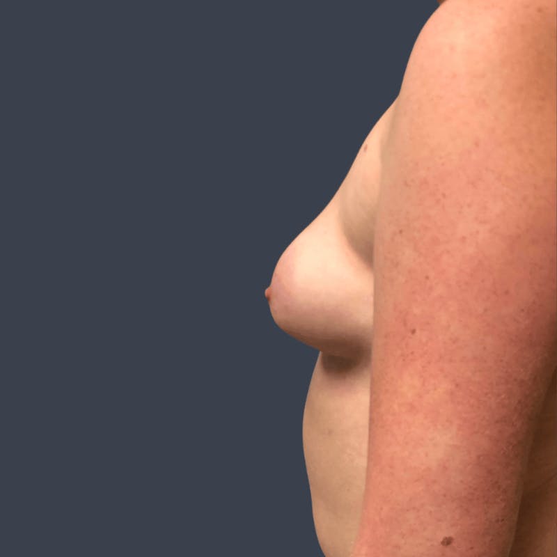 Breast Asymmetry / Tuberous Breasts Before & After Gallery - Patient 133206 - Image 3