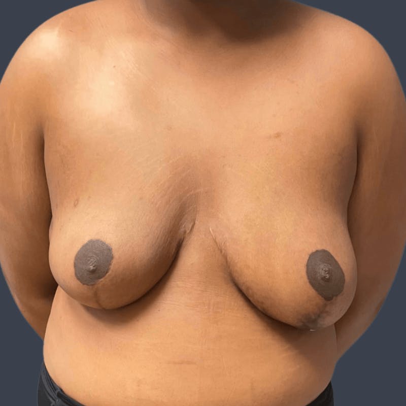 Breast Asymmetry / Tuberous Breasts Before & After Gallery - Patient 310945 - Image 2
