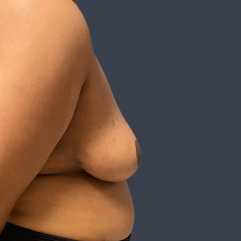 Breast Asymmetry / Tuberous Breasts Before & After Gallery - Patient 310945 - Image 4