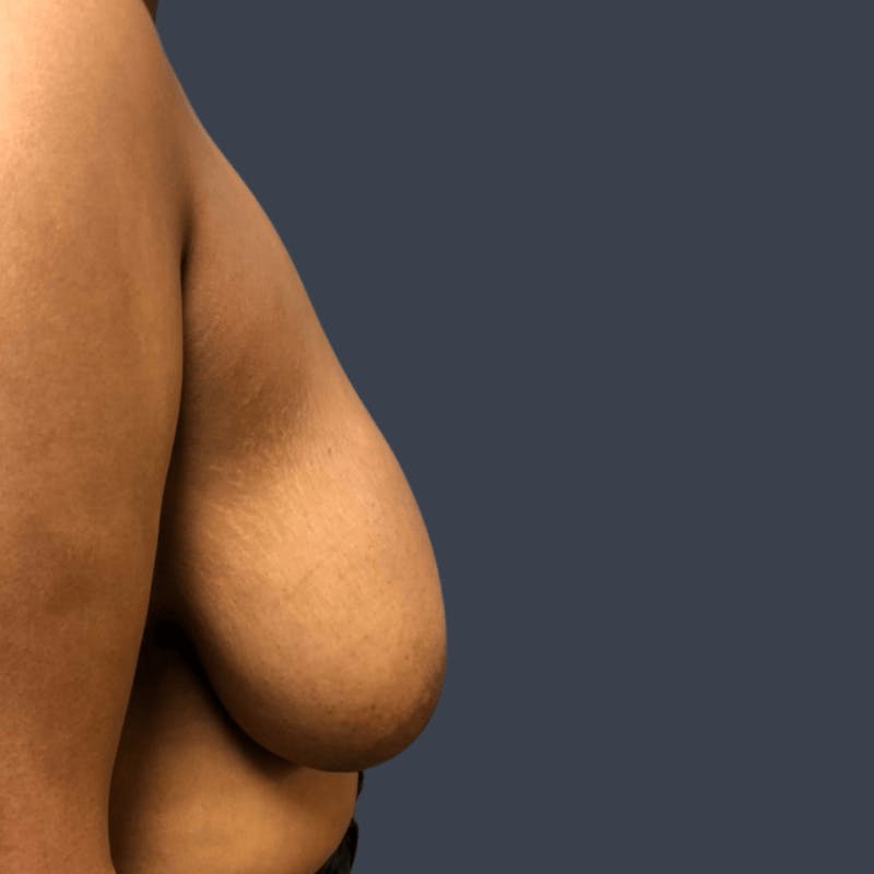 Breast Asymmetry / Tuberous Breasts Before & After Gallery - Patient 310945 - Image 3