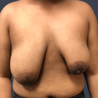 Breast Asymmetry / Tuberous Breasts Before & After Gallery - Patient 310945 - Image 1