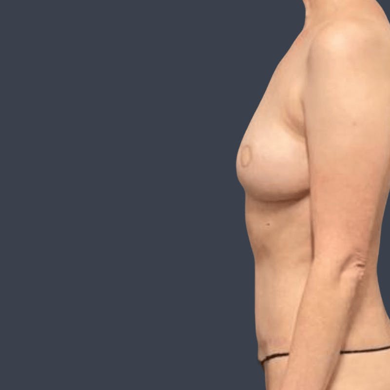 DIEP Flap Before & After Gallery - Patient 972736 - Image 6