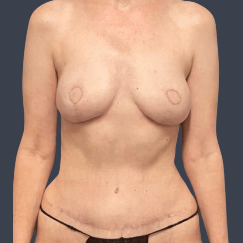 DIEP Flap Before & After Gallery - Patient 972736 - Image 2