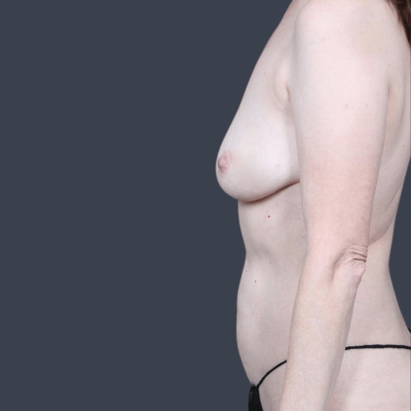 DIEP Flap Before & After Gallery - Patient 972736 - Image 5