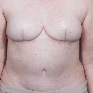 DIEP Flap Before & After Gallery - Patient 923311 - Image 2