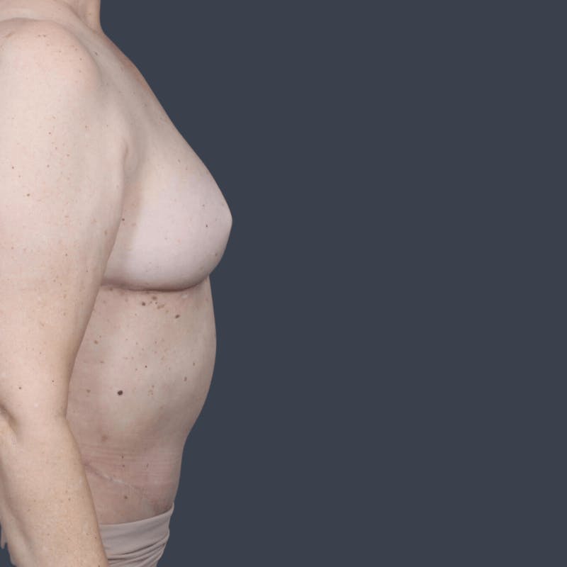 DIEP Flap Before & After Gallery - Patient 923311 - Image 6