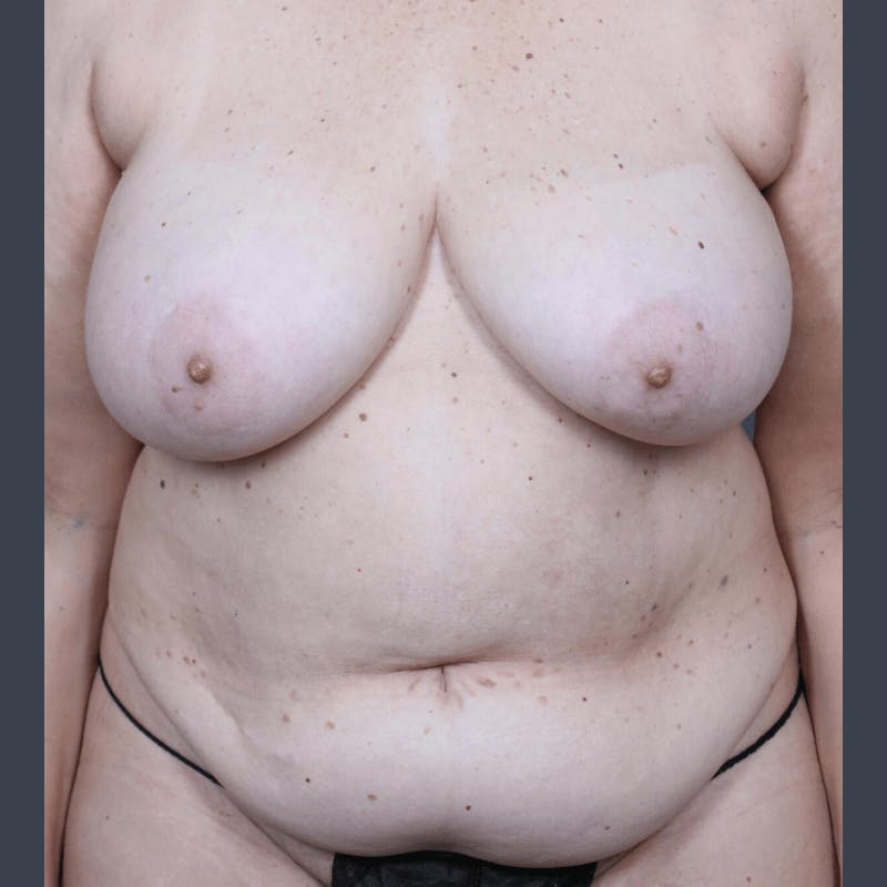 DIEP Flap Before & After Gallery - Patient 923311 - Image 1