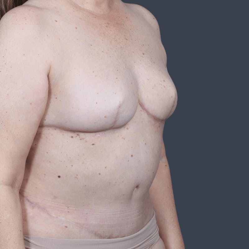 DIEP Flap Before & After Gallery - Patient 923311 - Image 4