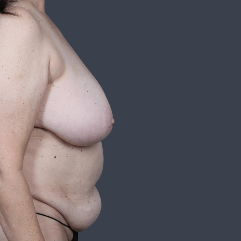 DIEP Flap Before & After Gallery - Patient 923311 - Image 5