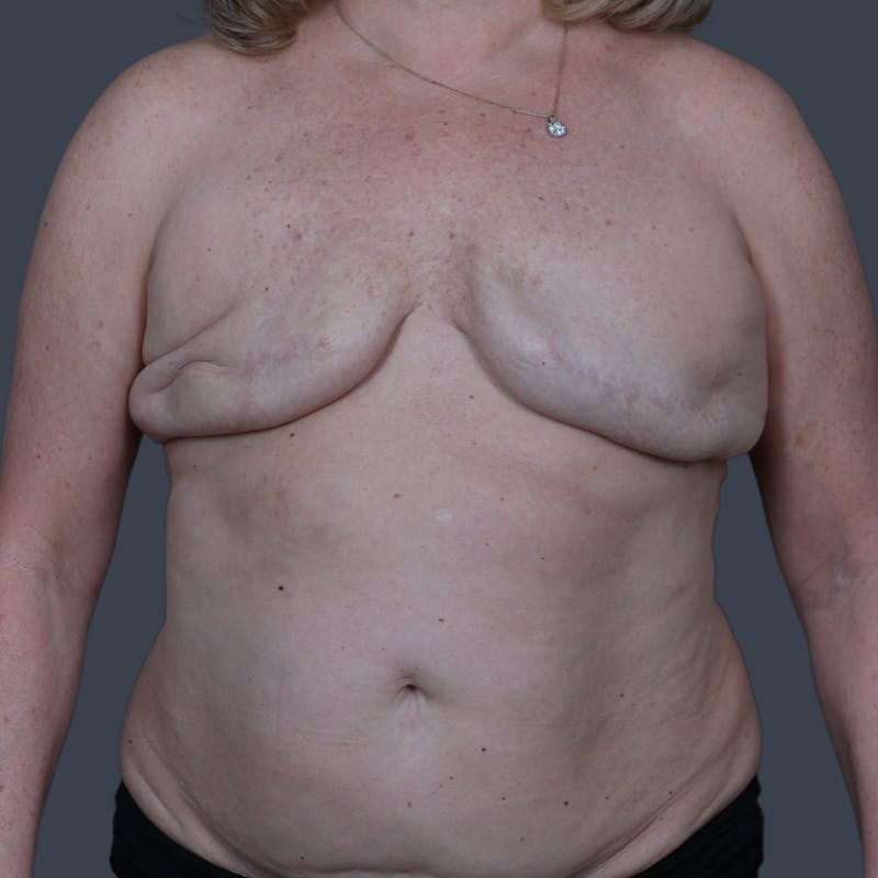DIEP Flap Before & After Gallery - Patient 353573 - Image 3
