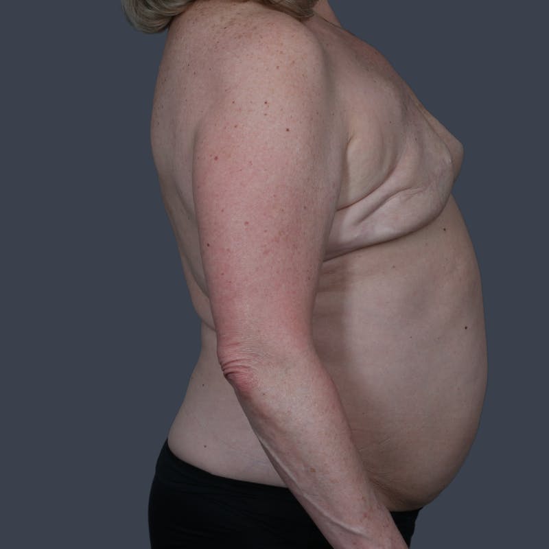 DIEP Flap Before & After Gallery - Patient 353573 - Image 5