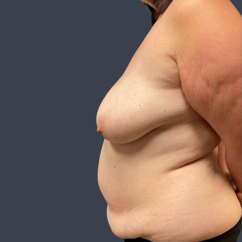 DIEP Flap Before & After Gallery - Patient 508073 - Image 5