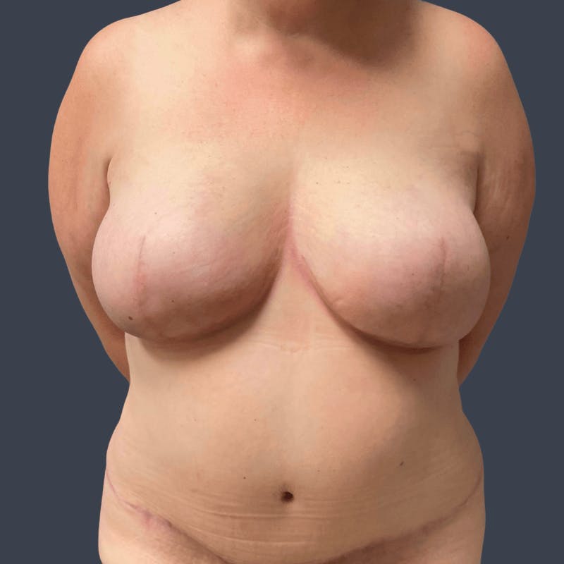 DIEP Flap Before & After Gallery - Patient 508073 - Image 2