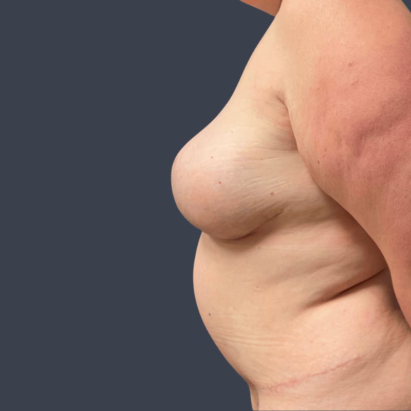 DIEP Flap Before & After Gallery - Patient 508073 - Image 6
